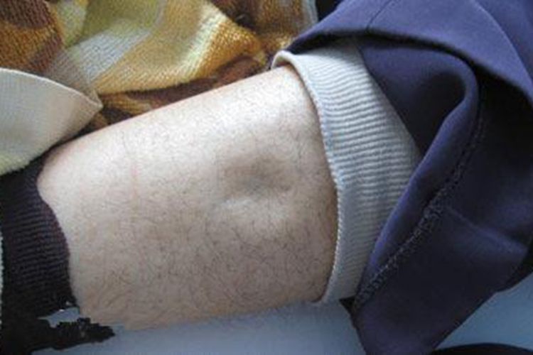 肾虚下肢水肿图 肾虚下肢水肿图