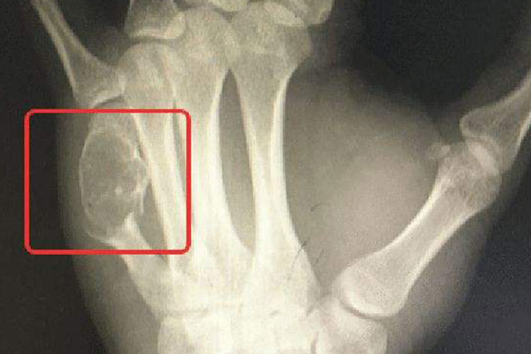 骨癌长刺影像图