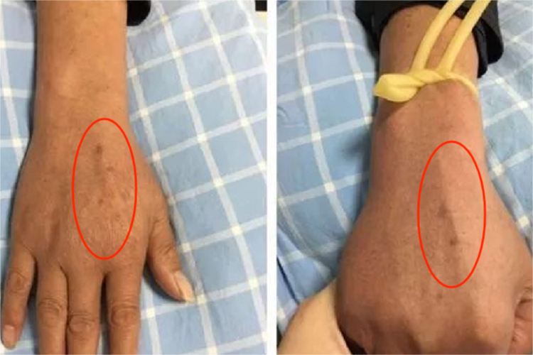 升白针静脉滴注部位图 升白针静脉滴注部位图