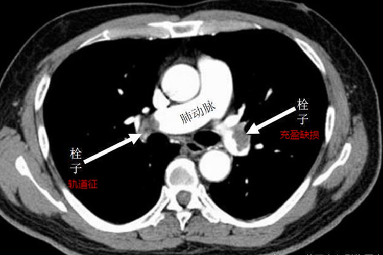 肺栓塞影像图 肺栓塞影像图