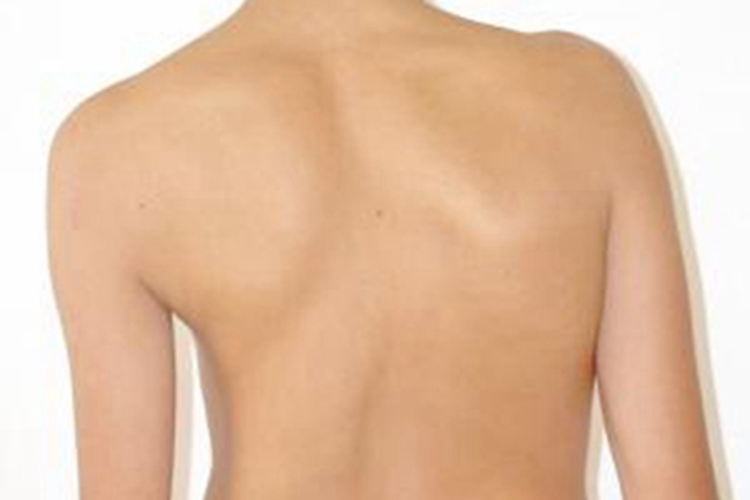 青年性驼背背部侧弯畸形图