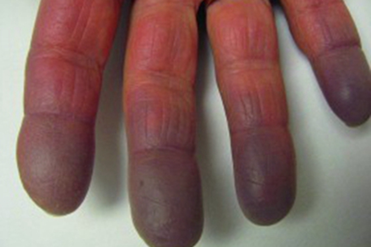 雷诺综合征皮肤青紫图 雷诺综合征皮肤青紫图