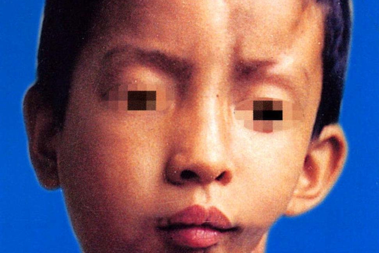 面部偏侧萎缩图 面部偏侧萎缩图