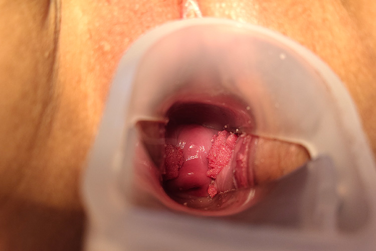 阴道尖锐湿疣图 阴道尖锐湿疣图