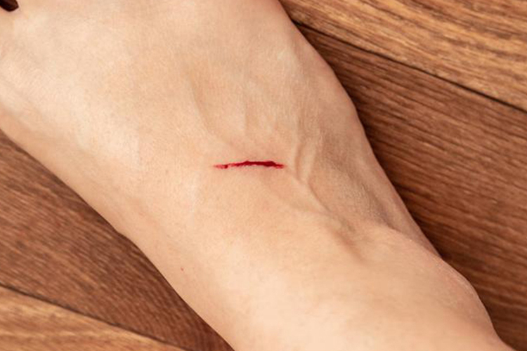 脚背毛细血管破裂出血图