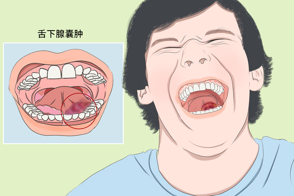 舌下腺位置图片