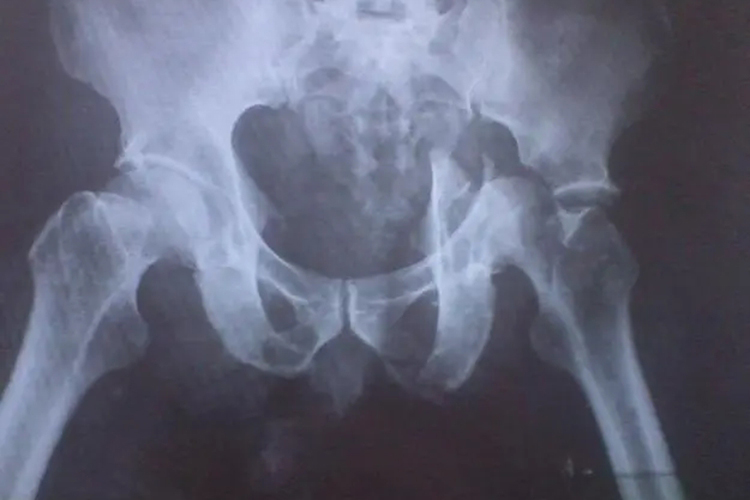 髋关节中心性脱位图