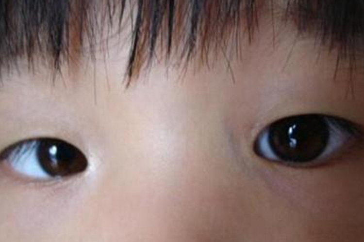 儿童轻度内斜视图 儿童轻度内斜视图