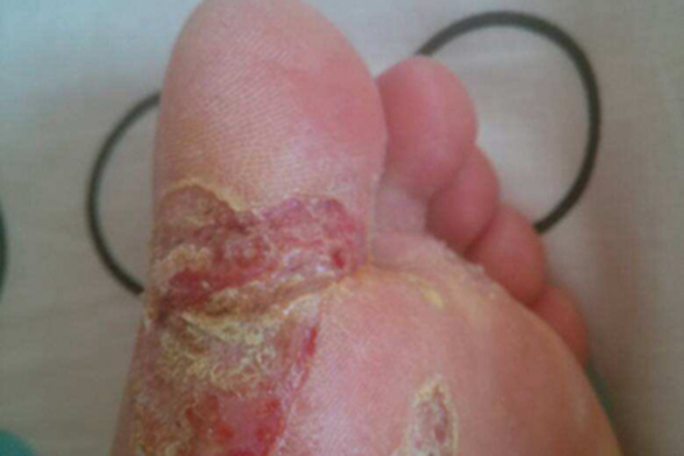 深脓疱疮脚部糜烂图 深脓疱疮脚部糜烂图