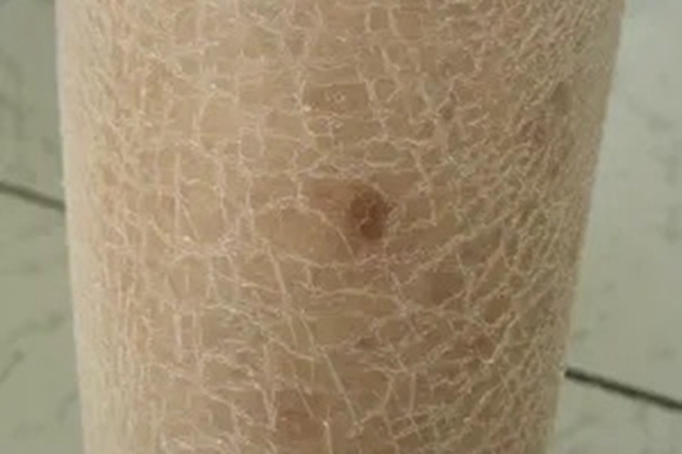 皮脂缺乏症症状图