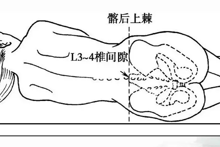脑脊液穿刺部位体表图