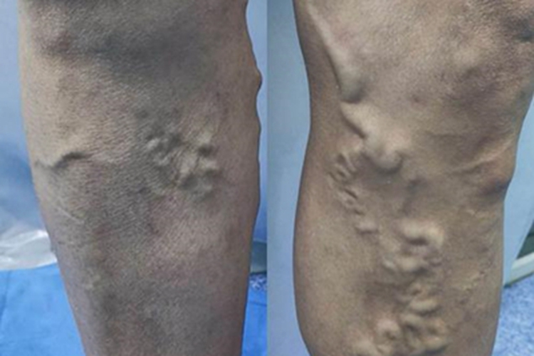 大隐静脉曲张疙瘩图