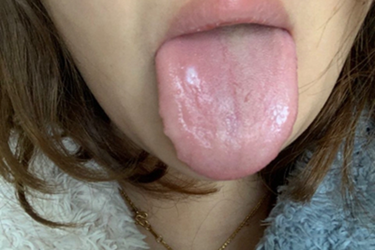 扁平苔藓舌头一块白斑图 扁平苔藓舌头一块白斑图