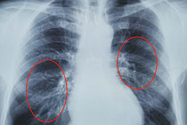 尘肺一期的高千伏胸片图