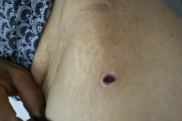 恙虫病腰部症状图 恙虫病腰部症状图