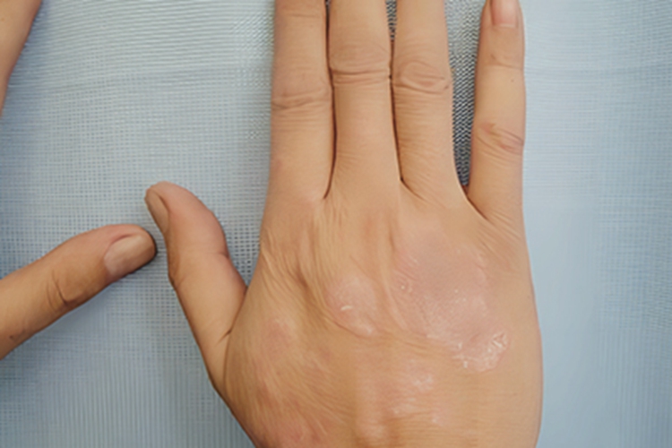 银屑病好转手背圆斑图