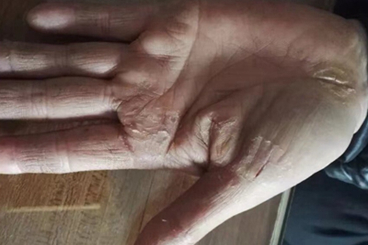 皲裂性湿疹手掌皮肤开裂图 皲裂性湿疹手掌皮肤开裂图