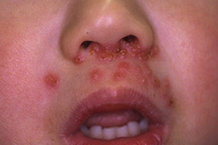 药物过敏性口炎面部结痂图 药物过敏性口炎面部结痂图
