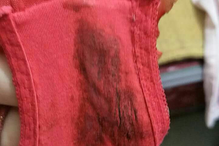 宫颈癌晚期内裤上血液图