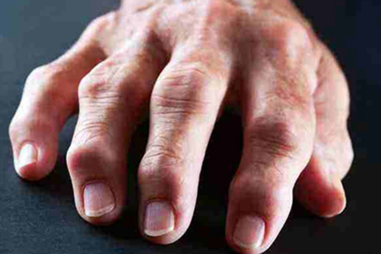 混合性结缔组织病手指肿胀图