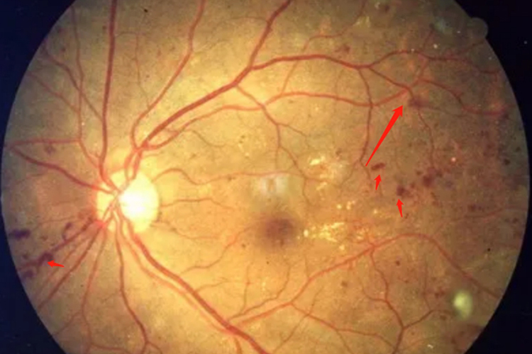 视网膜毛细血管瘤眼底囊肿图