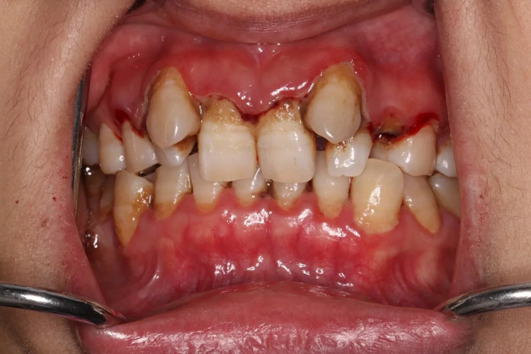 急性坏死性牙龈炎图 急性坏死性牙龈炎图