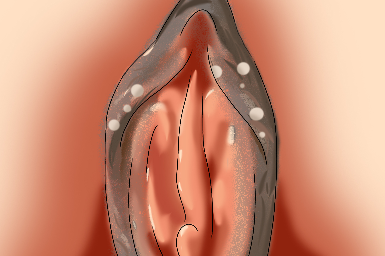 外阴界限清晰白斑图