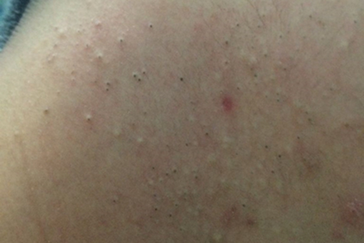 黑头脖子一侧有黑点图 黑头脖子一侧有黑点图