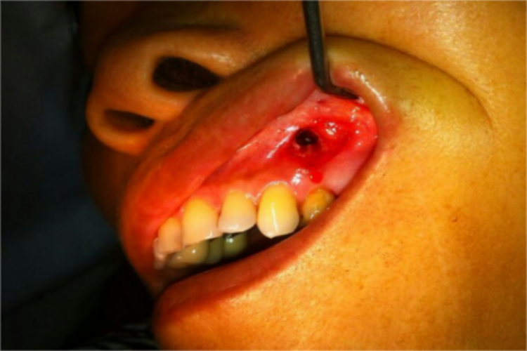 口腔癌手术后瘘管图