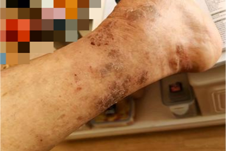 慢性湿疹脚踝周围结痂图