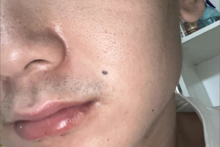 交界痣面部症状图