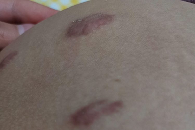 瘢痕疙瘩腹部有突起红疙瘩图 瘢痕疙瘩腹部有突起红疙瘩图