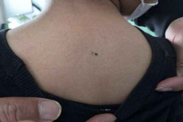 复合痣背部疙瘩图