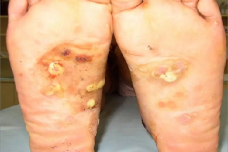 皮肤非典型分枝杆菌病脚底症状图