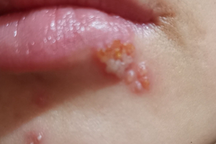 口唇疱疹嘴唇化脓图 口唇疱疹嘴唇化脓图