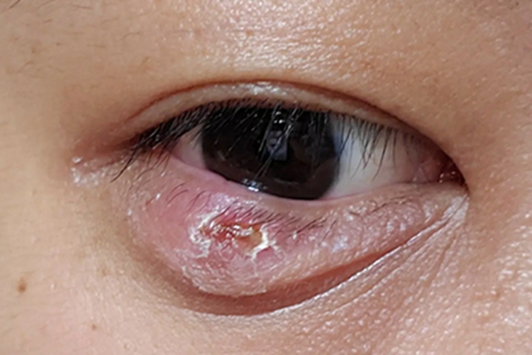 麦粒肿术后图