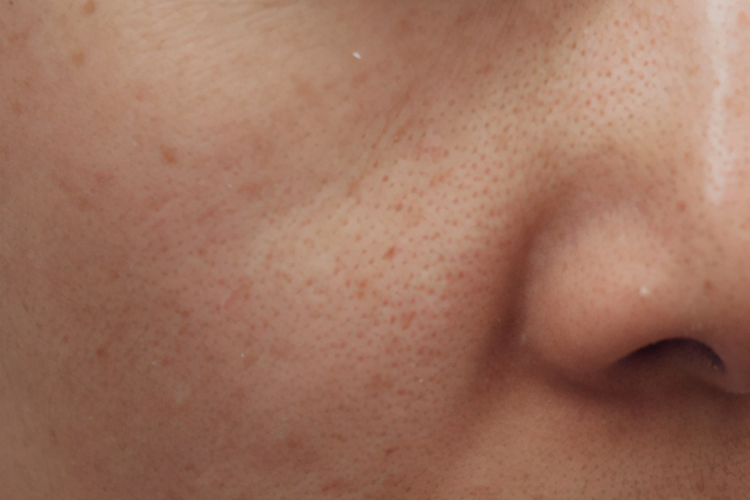 橘皮脸图 橘皮脸图