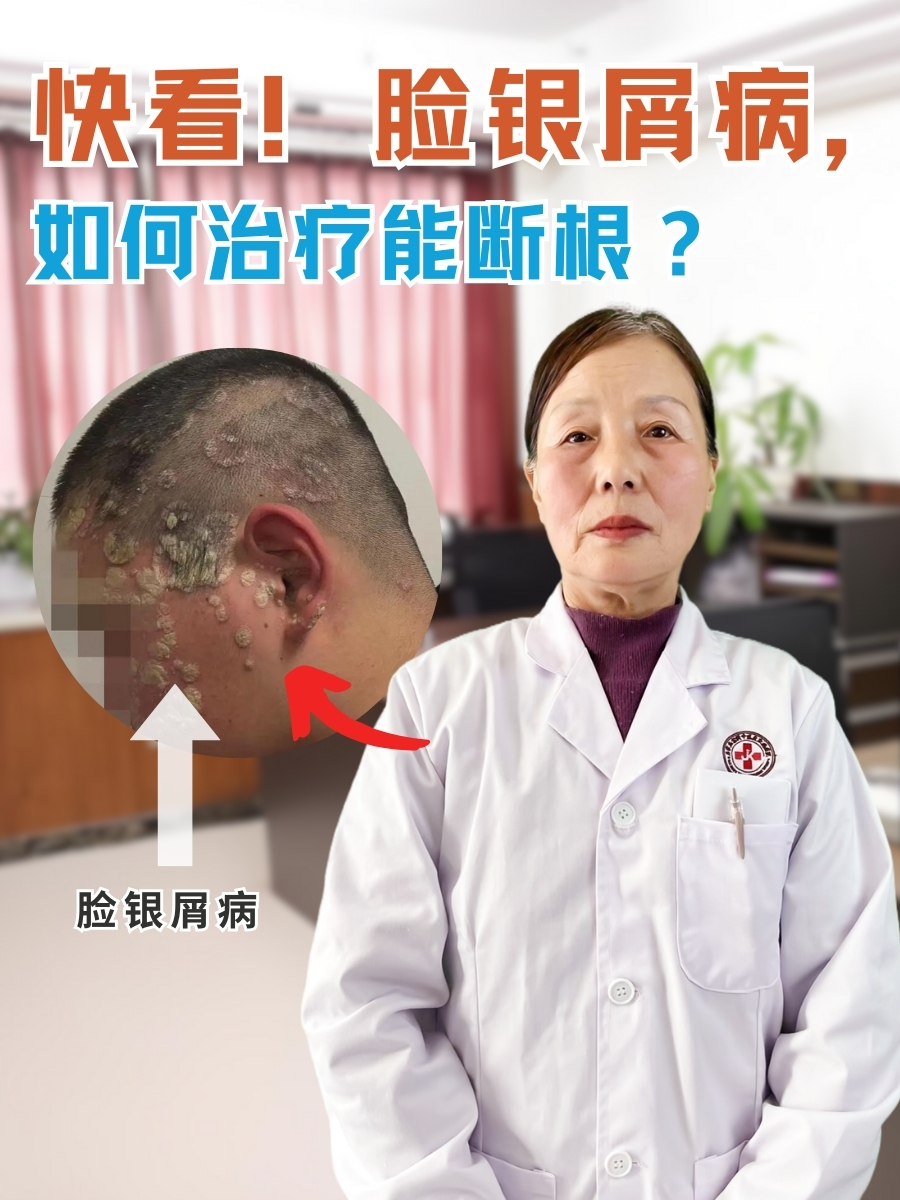 快看!脸银屑病,如何治疗能断根?