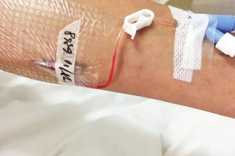 儿童留置针回血正常图