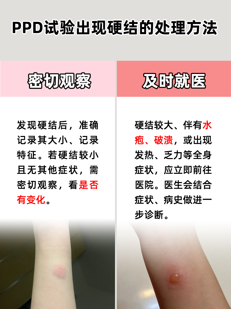 好奇！PPD试验怎样才算出现硬结