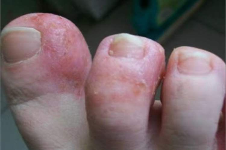 脚趾长水疱红肿结黄痂图