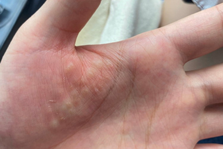 汗疱疹手掌长白色小水疱图 汗疱疹手掌长白色小水疱图