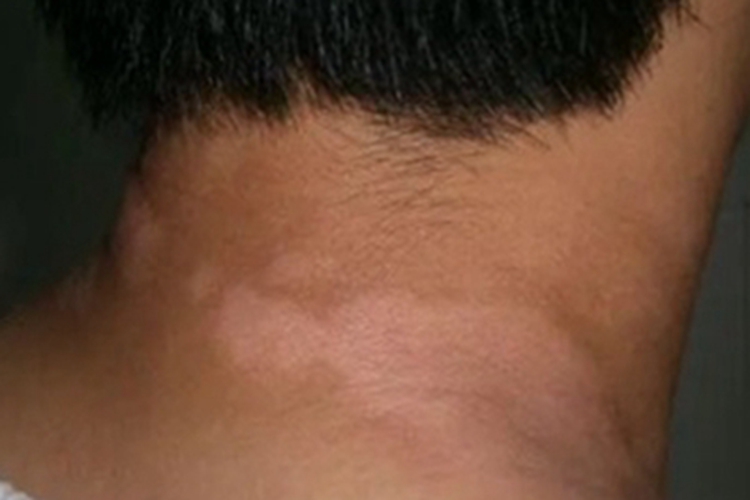 花斑糠疹颈部红斑图