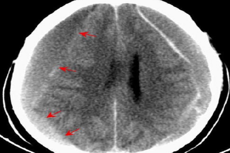 宝宝摔到头骨膜下血肿图 宝宝摔到头骨膜下血肿图