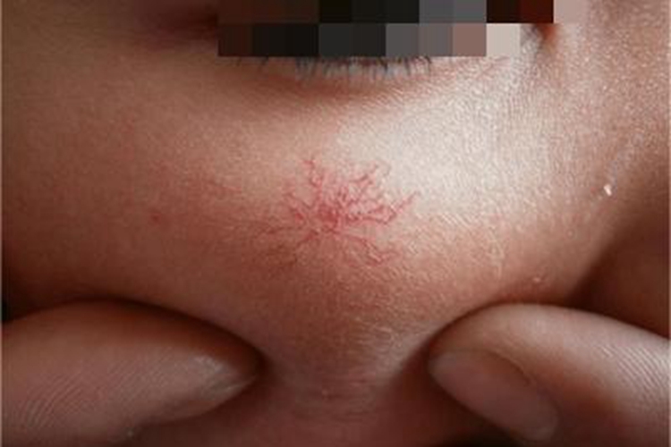 肝硬化面部红痣图