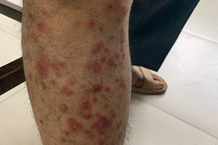 蚂蚁咬了全身过敏图 蚂蚁咬了全身过敏图