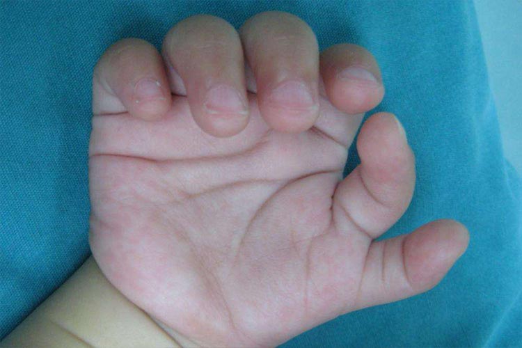 唐氏儿多指畸形图
