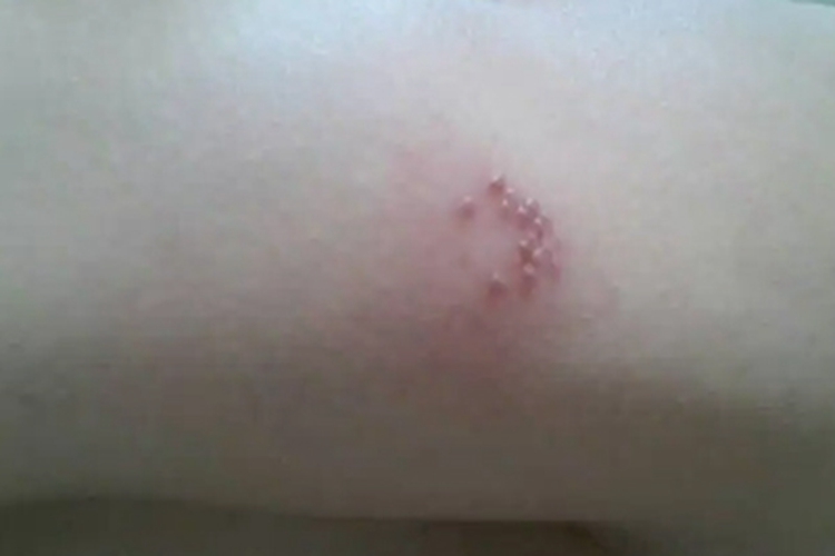 手臂内侧长单纯疱疹图