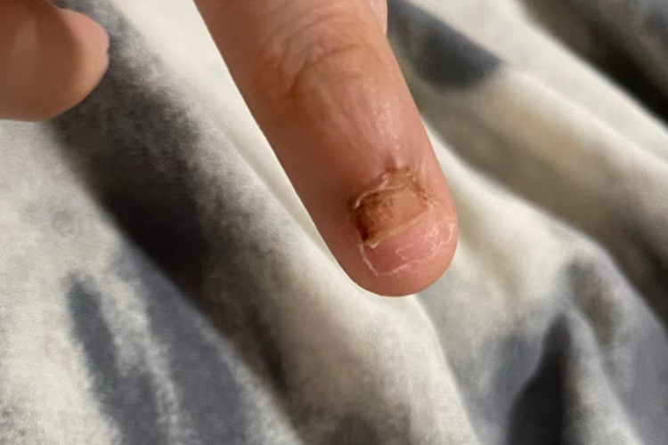 手指拔甲后结痂图