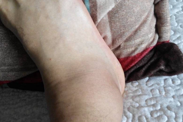 踝扭伤脚踝出现一个大包图